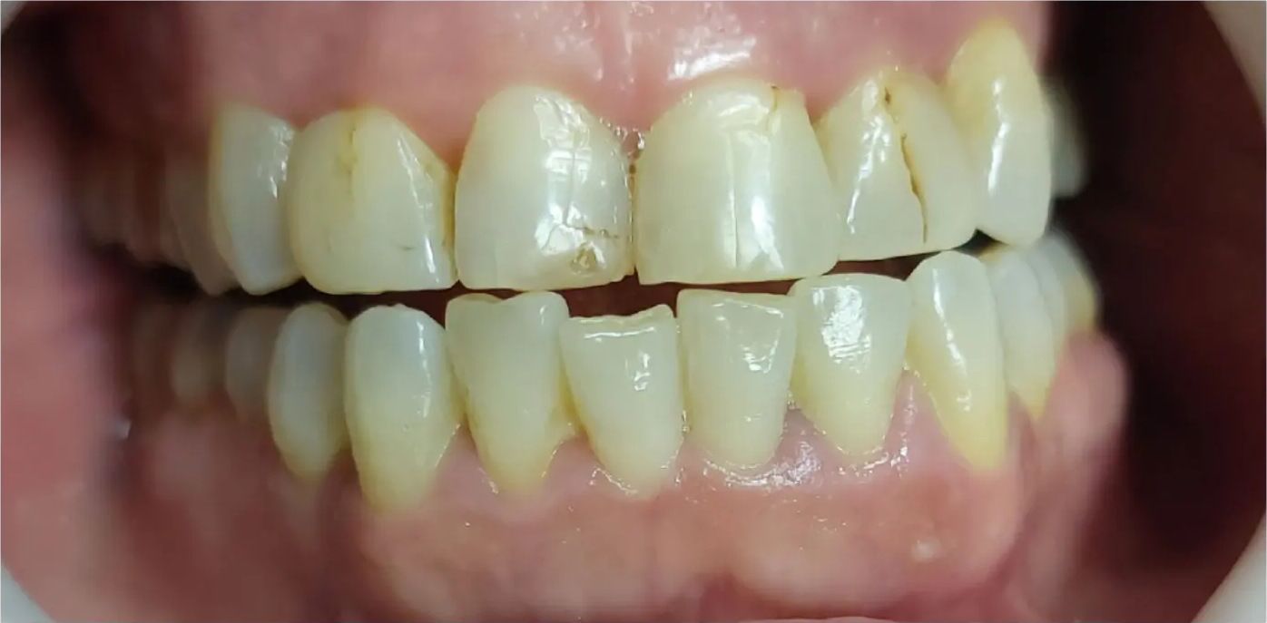 Before: stained and cracked front teeth