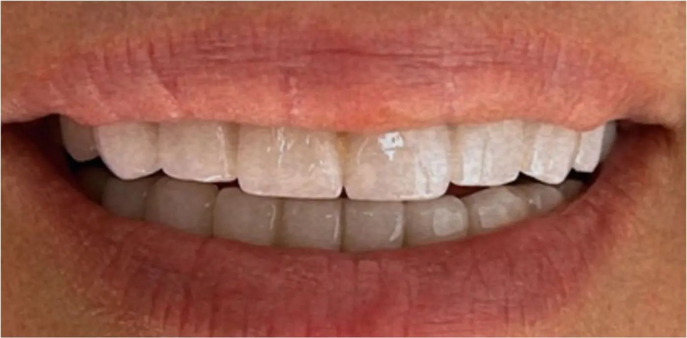 After: the teeth after veneers