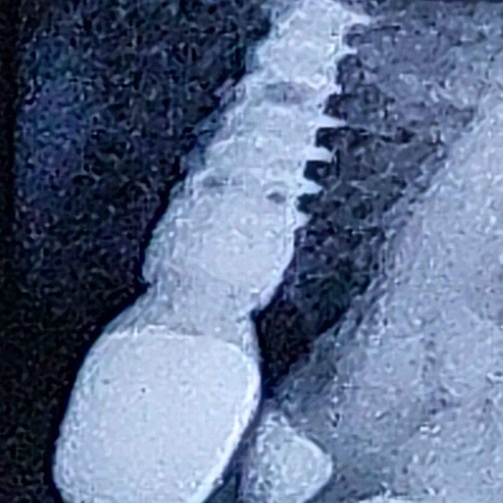 Follow-up radiograph of a dental implant, six years after placement