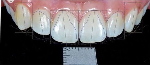 A digital smile design: the proportions of the front teeth planned on screen, with a measuring scale