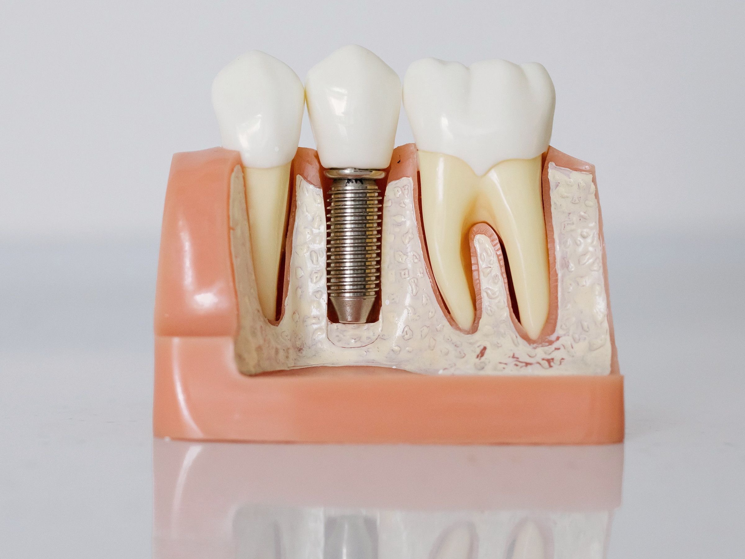 Model of a dental implant between two natural teeth, showing the implant post in the bone